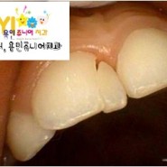 [용인쥬니어치과]아이가 넘어져서 치아를 다쳤어요! 치아를 다친경우, 유치 치아의 외상.