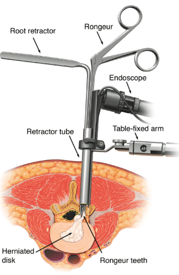 MLD (Microscopic Lumbar Disectomy) : 네이버 블로그