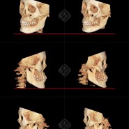 넓은 턱뼈 갸름하고 자연스러운 V라인으로 : T절골 턱끝줄이기 실제수술전후사진 및 CT