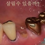 [치아정출술, 치관연장술] 부러진 치아 살리기, surgical extrusion의 실제 by 분당 치과보존과