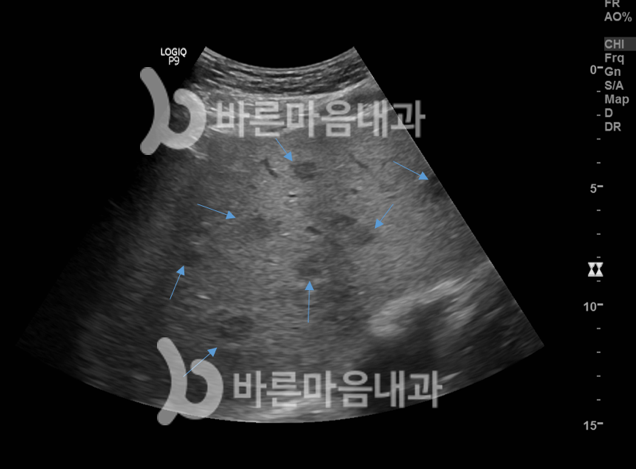 복부 초음파 검사는 간, 담낭, 췌장 종양 발견도 잘하는 강동구 내과에서! : 네이버 블로그