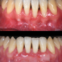 치아교정 부작용 잇몸퇴축(=잇몸내려앉음) 회복을 위한 잇몸재생 치료(=치은이식)에 대하여, 강남구 치과