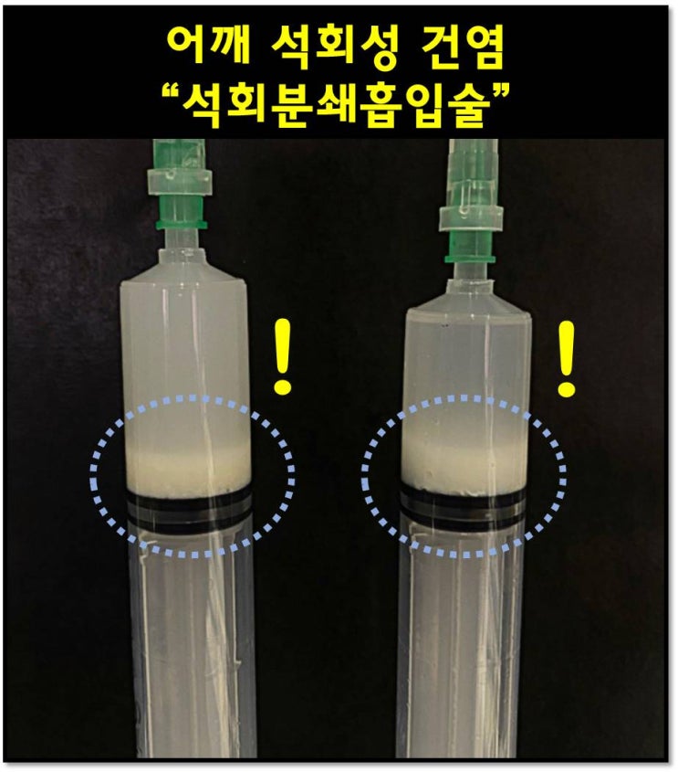 (플래티넘의원)석회를 주사로 흡입해서 제거하는 것이 가능한가?