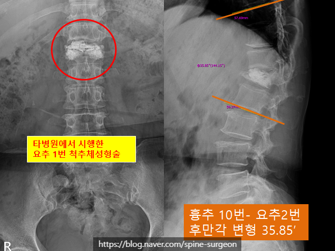 양측 엉치통증과 다리 힘이 빠져서 걷기 힘들어요 (요추 1번 압박골절로 인한 척수 압박, 요추 2-3번간 경막내 수외종양 ...