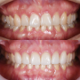 앞니라미네이트 : 깨진앞니와 치열 및 치아색상 개선을 위한 치아성형치료+라미네이트 삭제량 / 삼성동치과