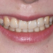 [잇몸성형방법] 잇몸뼈돌출 + 치은증식으로 인한 짧은 치아 치관의 심미적 개선을 위해, 봉은사역 치과