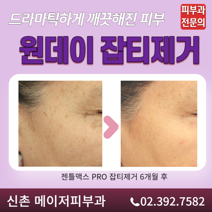얼굴 검버섯 제거 검버섯 치료 일광 흑자 레이저 피부 잡티 치료 효과 비용 가격 피부과전문의 신촌 메이저피부과 홍대 이대 공덕 ...