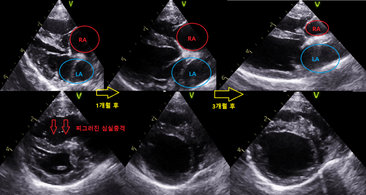 강아지심장병 / 폐성고혈압 / PH / Group 1 / 선천성심장병 / PDA / L to R shunt / ACDO / 개구 ...