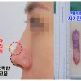 자가진피코수술, 실리콘비침&굴곡진 콧대라인 개선!(서울성형외과)