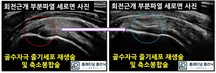 (플래티넘의원)회전근개 파열, 방치하면 안됩니다.