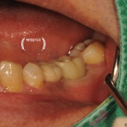 하남미사 베테랑치과 임플란트 보철 우수증례 no.1