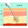 성형외과 :: 지방 흡입 수술 및 수술 후 나타날 수 있는 증상