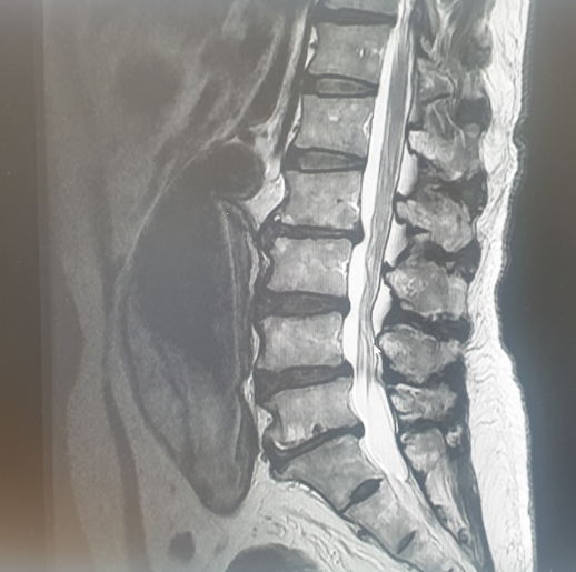 [조언] 허리 옆구리 통증으로 온 AAA(abdominal aortic aneurysm) impending rupture ...