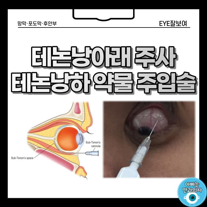 눈 염증을 치료하는 테논낭하 주사, 테논낭 아래 약물 주입술 : 네이버 블로그