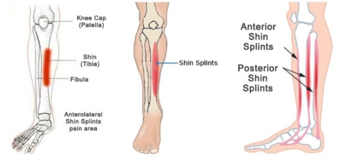 shin-splint, MTSS(Medial Tibia Stress Syndrom) 신스프린트, 내측 경골 스트레스 증후군 ...