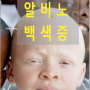 5살 알비노 어린이 머리·다리 잘려 살해 주술 목적 백색증 원인 증상 치료