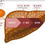 지방간 약 치료제 종류 및 신약개발현황(비알콜성지방간 NASH 치료제)