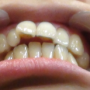치아 건강과 뇌건강의 열쇠 턱관절 서초동한의원