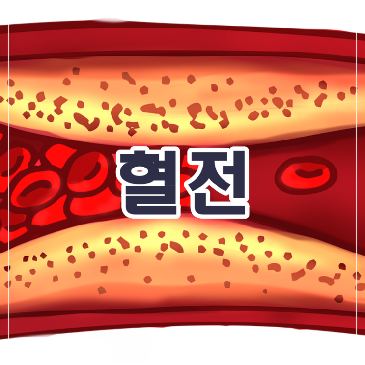 혈전 증상 혈전증 예방법 : 네이버 블로그