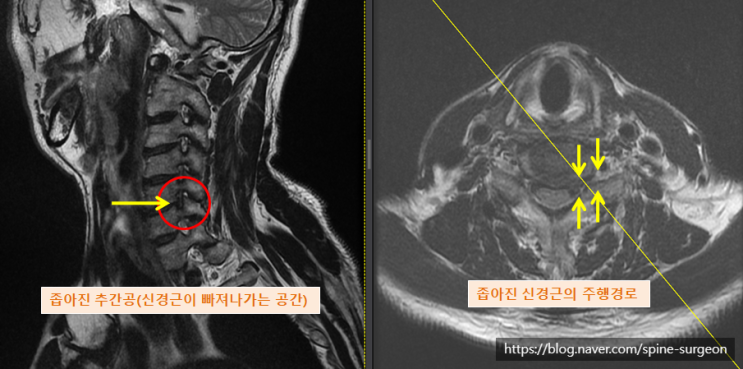 왼쪽 어깨부터 상완까지 저리고 아파요 (경추 5-6번간 좌측 추간공 협착증 및 추간판의 팽윤,늘어남) : 네이버 블로그