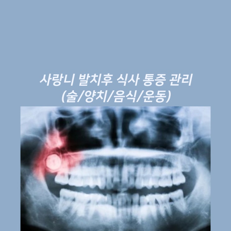 사랑니 발치후 식사 통증 관리(술/양치/음식/운동) : 네이버 블로그