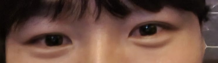 남자 부분절개 쌍수 후기 2달차 (광고X, 내돈내쌍, 속쌍, 눈매교정,가성안검하수) : 네이버 블로그
