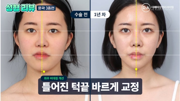 사각턱윤곽수술로 얼굴비대칭까지 교정 가능할까? : 네이버 블로그