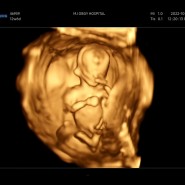 임신 11주~15주차 증상 1차 기형아 검사 시기