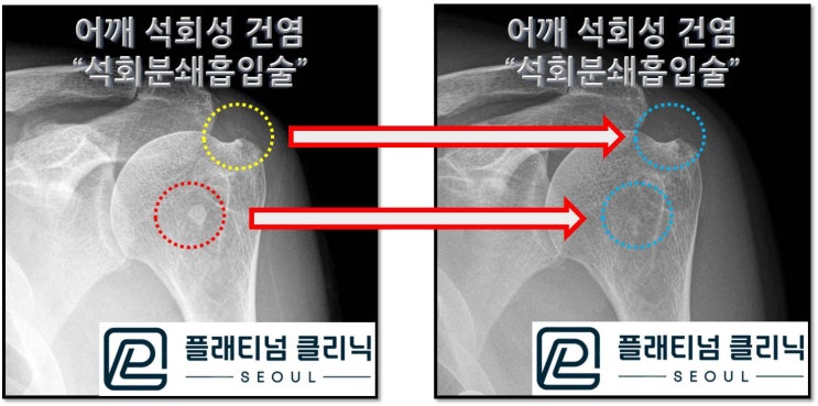(플래티넘의원) 수술없이 5년간의 석회성 건염의 고통에서 벋어나다.