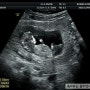 임신12주차 증상 및 1차 기형아검사 후기(목투명대,피검사)