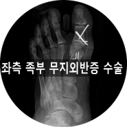 [부산 성가병원] 좌측 족부 무지외반증 환자분의 수술 사례입니다.