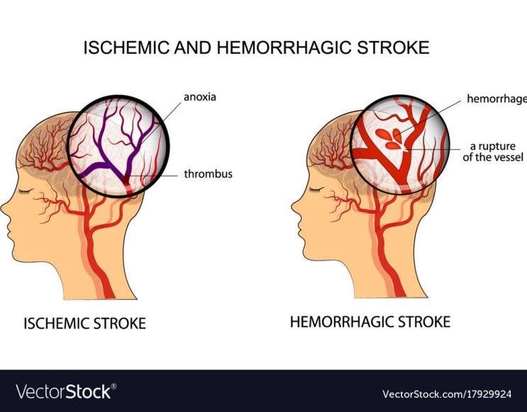 뇌줄중(Stroke), 뇌경색(Cerebral infarction) and 뇌출혈(Cerebral hemorrhage) 개요 및 ...