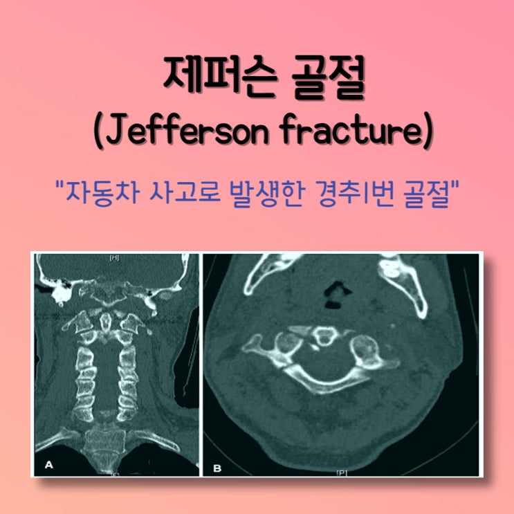 경추1번 골절 보상쟁점 검토 : 네이버 블로그