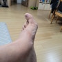 나의 고생하는 왼발 재활마사지 재활훈련