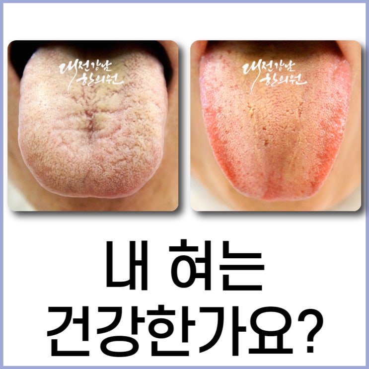 설진: 혀색깔 모양 보고 내 건강상태 진단하는 방법 : 네이버 블로그