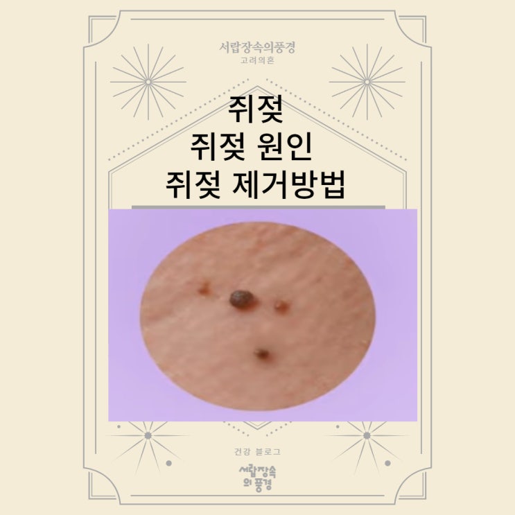 쥐젖 원인 목 쥐젖 원인 쥐젖 제거 방법 연성섬유종 원인 제거방법 : 네이버 블로그