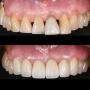 앞니 지르코니아 크라운 치료로 치아마모와 잇몸퇴축으로 인한 심미적 문제를 개선. 삼성동 치과