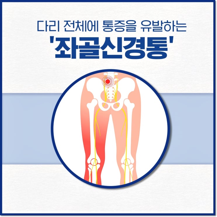 다리 전체에 통증을 줄 수 있는 '좌골신경통' : 네이버 블로그