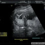 임신 15주6일 '2차 기형아검사 및 성별확인'(산후조리원 예약)
