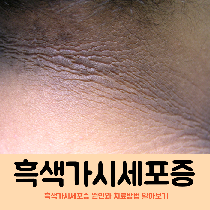 흑색가시세포증 흑색극세포증 목 겨드랑이 사타구니 회색 갈색 색소침착 원인 치료 약 레이저 : 네이버 블로그