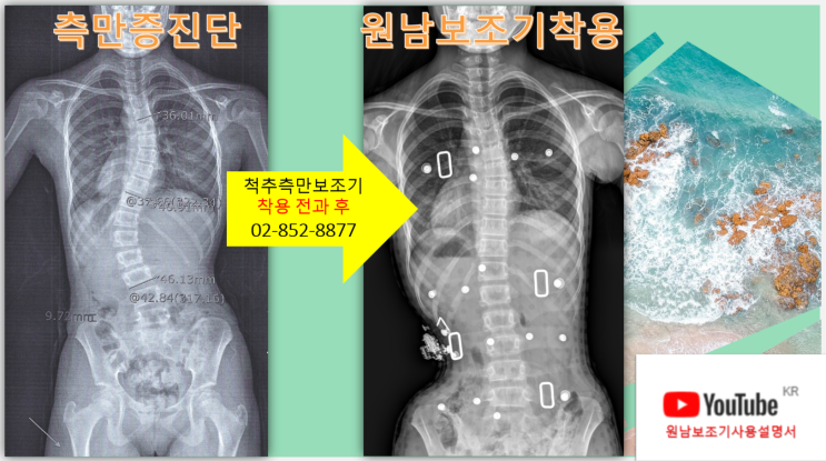 흉추38 요추43 고각도 측만증의 보조기 착용후 경과모습:원남보조기 효과 : 네이버 블로그