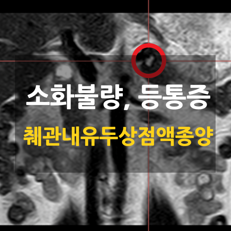 [진단사례] 소화불량, 등통증 > 췌관내유두상점액종양 #췌장물혹 : 네이버 블로그