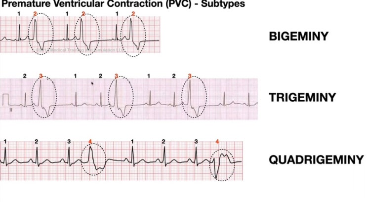 VPC/ Ventricular Premature Contraction : 네이버 블로그