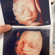 [쌍둥이 임신 27주차] 입체초음파, 임당검사