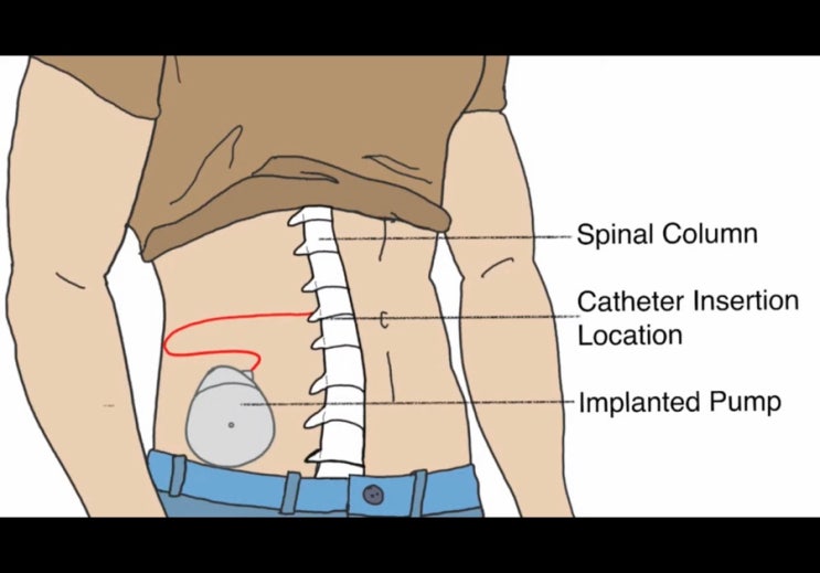 Baclofen 바클로펜 Intrathecal pump 척수강내 약물주입펌프 공부하기 : 네이버 블로그
