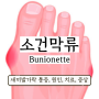 소건막류 원인 치료 증상 새끼발가락 통증 (Tailor's bunion/Bunionette)
