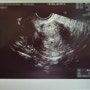 [임신5주차] 임신극초기 증상 , 임산부 일상, 산부인과