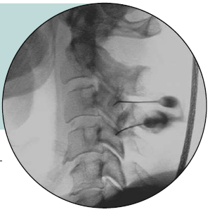 경추부 내측 분지 차단술(Cervical Medial branch block) : 네이버 블로그