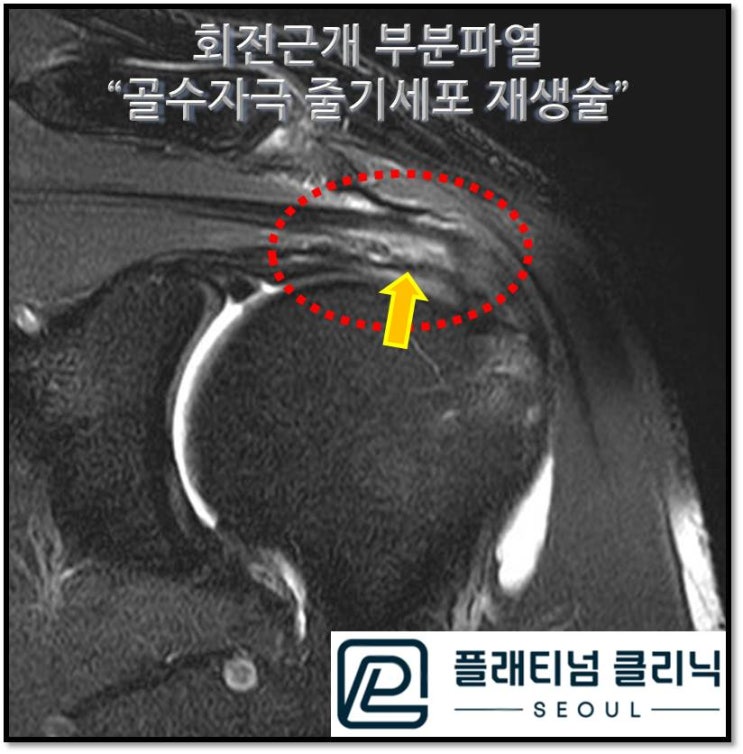 (플래티넘의원)오래된 어깨 통증, 회전근개 파열 비수술적으로 치료하는 방법.