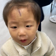 아이 이마 열상 찢어짐 사고 봉합 수술 후 흉터 변화 3개월 경과